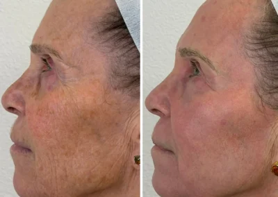 Alpha Medical Aesthetics Ablative Laser Resurfacing Lumenis UltraPulse Alpha CO2 Facial Treatment By Dr. Sassan Kaveh Anthem Las Vegas 233