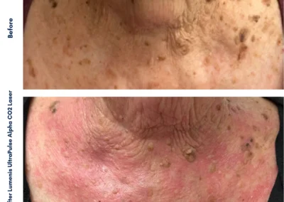 Alpha Medical Aesthetics Ablative Laser Resurfacing Lumenis UltraPulse Alpha CO2 Facial Treatment By Dr. Sassan Kaveh Canyon Gate Las Vegas 044