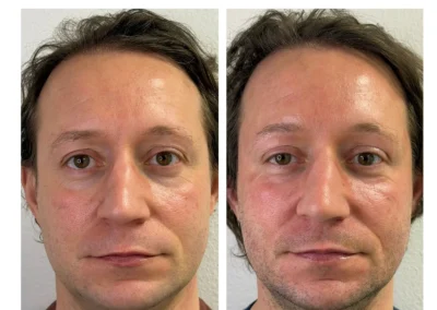 Alpha Medical Aesthetics Ablative Laser Resurfacing Lumenis UltraPulse Alpha CO2 Facial Treatment By Dr. Sassan Kaveh Canyon Gate Las Vegas 241
