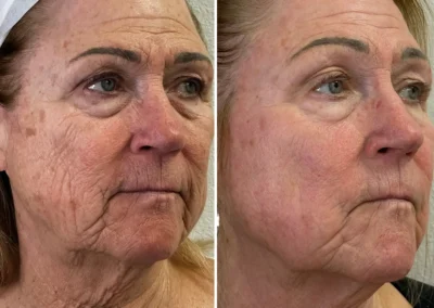 Alpha Medical Aesthetics Ablative Laser Resurfacing Lumenis UltraPulse Alpha CO2 Facial Treatment By Dr. Sassan Kaveh Centennial Hills Las Vegas 006