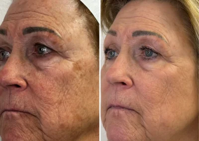 Alpha Medical Aesthetics Ablative Laser Resurfacing Lumenis UltraPulse Alpha CO2 Facial Treatment By Dr. Sassan Kaveh Centennial Hills Las Vegas 013