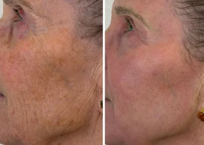 Alpha Medical Aesthetics Ablative Laser Resurfacing Lumenis UltraPulse Alpha CO2 Facial Treatment By Dr. Sassan Kaveh Desert Shores Las Vegas 235