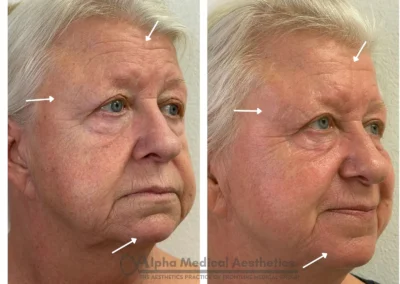Alpha Medical Aesthetics Ablative Laser Resurfacing Lumenis UltraPulse Alpha CO2 Facial Treatment By Dr. Sassan Kaveh Desert Shores Las Vegas 236