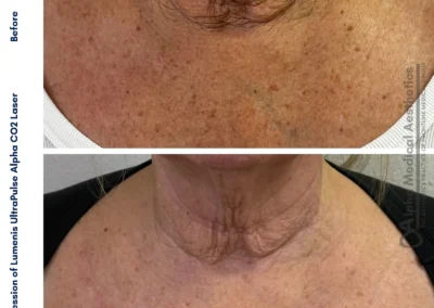 Alpha Medical Aesthetics Ablative Laser Resurfacing Lumenis UltraPulse Alpha CO2 Facial Treatment By Dr. Sassan Kaveh Downtown Las Vegas 010
