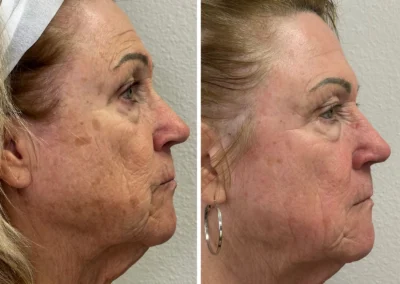 Alpha Medical Aesthetics Ablative Laser Resurfacing Lumenis UltraPulse Alpha CO2 Facial Treatment By Dr. Sassan Kaveh Henderson Las Vegas 004