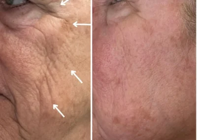 Alpha Medical Aesthetics Ablative Laser Resurfacing Lumenis UltraPulse Alpha CO2 Facial Treatment By Dr. Sassan Kaveh MacDonald Highlands Las Vegas 003