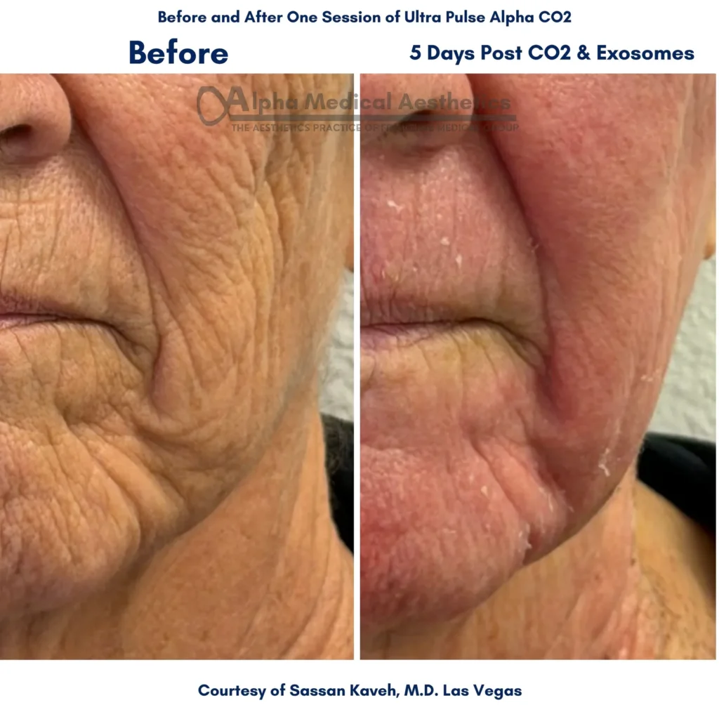 Alpha Medical Aesthetics Ablative Laser Resurfacing Lumenis UltraPulse Alpha CO2 Facial Treatment By Dr. Sassan Kaveh MacDonald Highlands Las Vegas 200 Alpha Medical Aesthetics Ablative Laser Resurfacing Lumenis UltraPulse Alpha CO2 Facial Treatment By Dr. Sassan Kaveh MacDonald Highlands Las Vegas 200