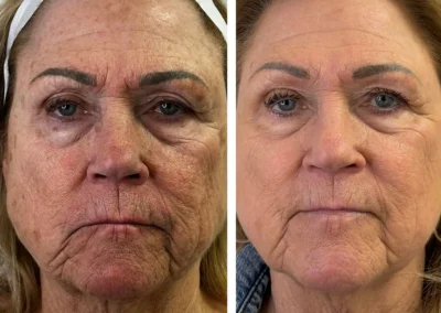 Alpha Medical Aesthetics Ablative Laser Resurfacing Lumenis UltraPulse Alpha CO2 Facial Treatment By Dr. Sassan Kaveh Mountains Edge Las Vegas 011