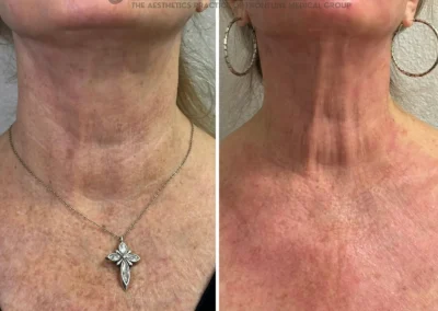 Alpha Medical Aesthetics Ablative Laser Resurfacing Lumenis UltraPulse Alpha CO2 Facial Treatment By Dr. Sassan Kaveh Mountains Edge Las Vegas 141