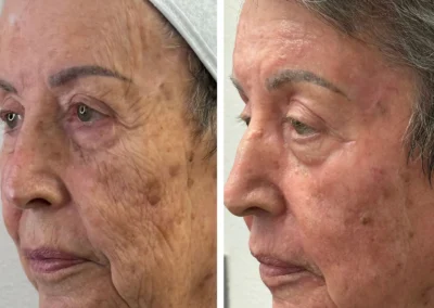 Alpha Medical Aesthetics Ablative Laser Resurfacing Lumenis UltraPulse Alpha CO2 Facial Treatment By Dr. Sassan Kaveh Peccole Ranch Las Vegas 045
