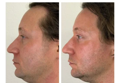 Alpha Medical Aesthetics Ablative Laser Resurfacing Lumenis UltraPulse Alpha CO2 Facial Treatment By Dr. Sassan Kaveh Peccole Ranch Las Vegas 239