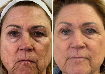 Alpha Medical Aesthetics Ablative Laser Resurfacing Lumenis UltraPulse Alpha CO2 Facial Treatment By Dr. Sassan Kaveh Skye Canyon Las Vegas 012