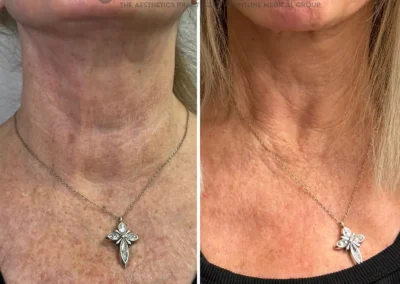 Alpha Medical Aesthetics Ablative Laser Resurfacing Lumenis UltraPulse Alpha CO2 Facial Treatment By Dr. Sassan Kaveh Southern Highlands Las Vegas 143