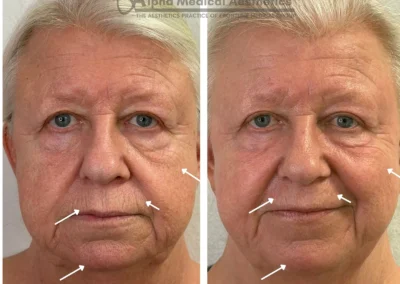 Alpha Medical Aesthetics Ablative Laser Resurfacing Lumenis UltraPulse Alpha CO2 Facial Treatment By Dr. Sassan Kaveh Southern Highlands Las Vegas 237