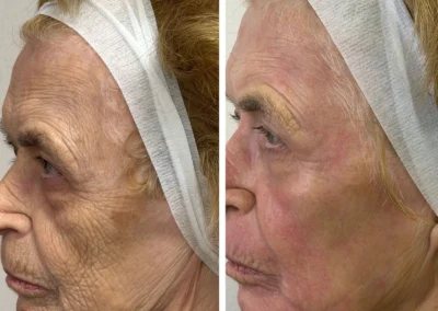 Alpha Medical Aesthetics Ablative Laser Resurfacing Lumenis UltraPulse Alpha CO2 Facial Treatment By Dr. Sassan Kaveh Southern Highlands Las Vegas 292