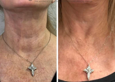 Alpha Medical Aesthetics Ablative Laser Resurfacing Lumenis UltraPulse Alpha CO2 Facial Treatment By Dr. Sassan Kaveh Spanish Trail Las Vegas 142