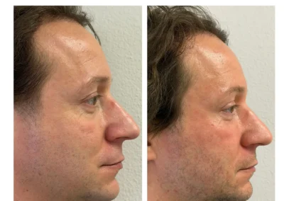Alpha Medical Aesthetics Ablative Laser Resurfacing Lumenis UltraPulse Alpha CO2 Facial Treatment By Dr. Sassan Kaveh Spanish Trail Las Vegas 238