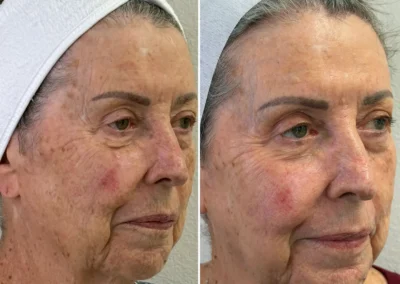 Alpha Medical Aesthetics Ablative Laser Resurfacing Lumenis UltraPulse Alpha CO2 Facial Treatment By Dr. Sassan Kaveh Sun City Summerlin Las Vegas 043