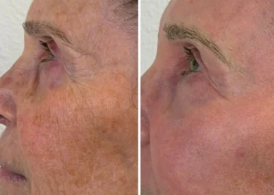 Alpha Medical Aesthetics Ablative Laser Resurfacing Lumenis UltraPulse Alpha CO2 Facial Treatment By Dr. Sassan Kaveh Sun City Summerlin Las Vegas 234