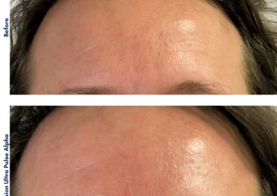 Alpha Medical Aesthetics Ablative Laser Resurfacing Lumenis UltraPulse Alpha CO2 Facial Treatment By Dr. Sassan Kaveh Sun City Summerlin Las Vegas 240