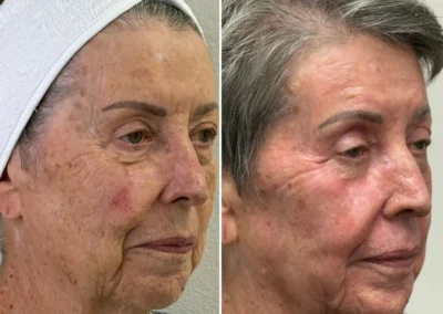 Alpha Medical Aesthetics Ablative Laser Resurfacing Lumenis UltraPulse Alpha CO2 Facial Treatment By Dr. Sassan Kaveh The Lakes Las Vegas 042
