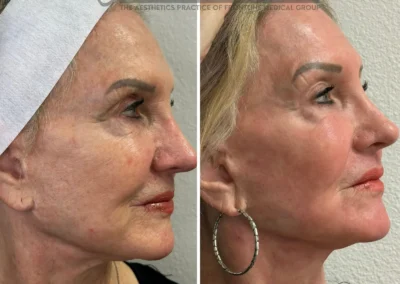 Alpha Medical Aesthetics Ablative Laser Resurfacing Lumenis UltraPulse Alpha CO2 Facial Treatment By Dr. Sassan Kaveh The Ridges Las Vegas 140