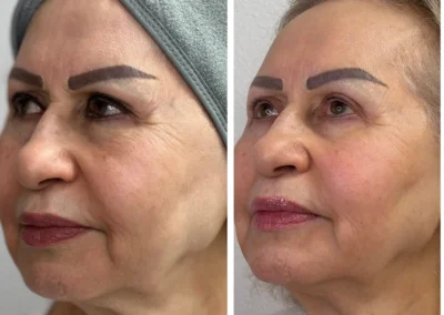 Alpha Medical Aesthetics Dual Lift Facial Treatment By Dr. Sassan Kaveh Anthem Las Vegas 299