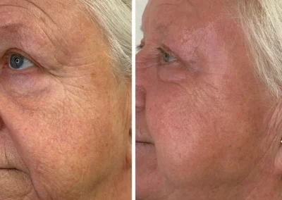 Alpha Medical Aesthetics Dual Lift Facial Treatment By Dr. Sassan Kaveh Canyon Gate Las Vegas 280