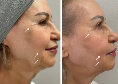 Alpha Medical Aesthetics Dual Lift Facial Treatment By Dr. Sassan Kaveh Southern Highlands Las Vegas 301