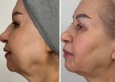 Alpha Medical Aesthetics Dual Lift Facial Treatment By Dr. Sassan Kaveh Southern Highlands Las Vegas 302