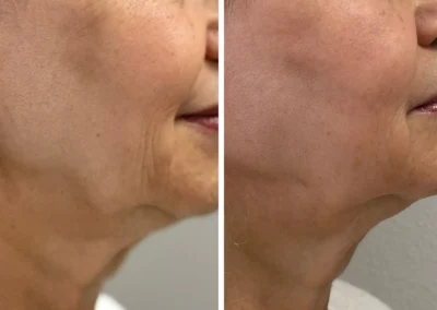 Alpha Medical Aesthetics Dual Lift Facial Treatment By Dr. Sassan Kaveh The Ridges Las Vegas 297