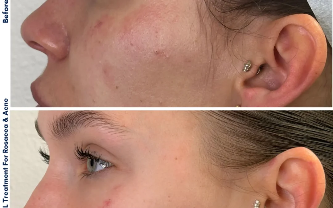 Erasing Summer Sun Damage: IPL Photofacial for Sun Spots in Las Vegas