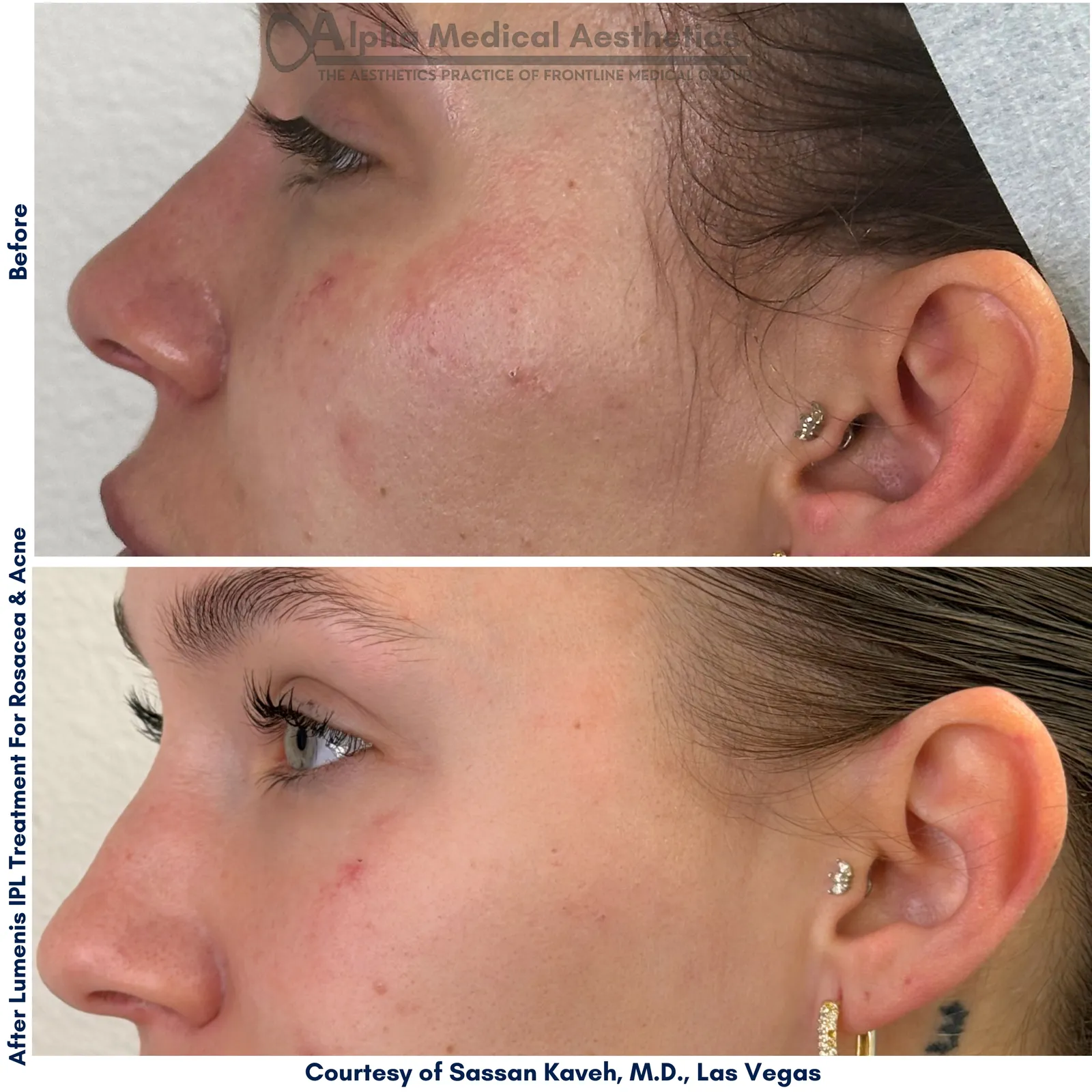 IPL photofacial in Las Vegas