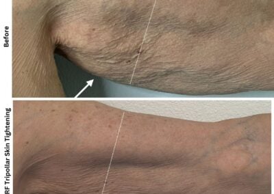 Alpha Medical Aesthetics Lumenis RF Skin Tightening By Dr Sassan Kaveh Las Vegas