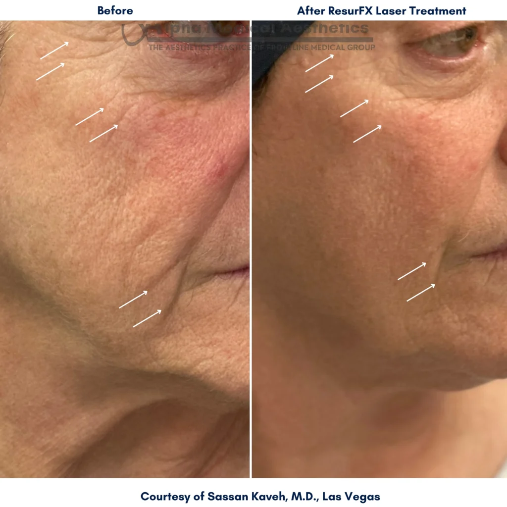 Alpha Medical Aesthetics Lumenis Resurfacing to Combat Aging With ResurFX By Dr Sassan Kaveh Las Vegas Alpha Medical Aesthetics Lumenis Resurfacing to Combat Aging With ResurFX By Dr Sassan Kaveh Las Vegas