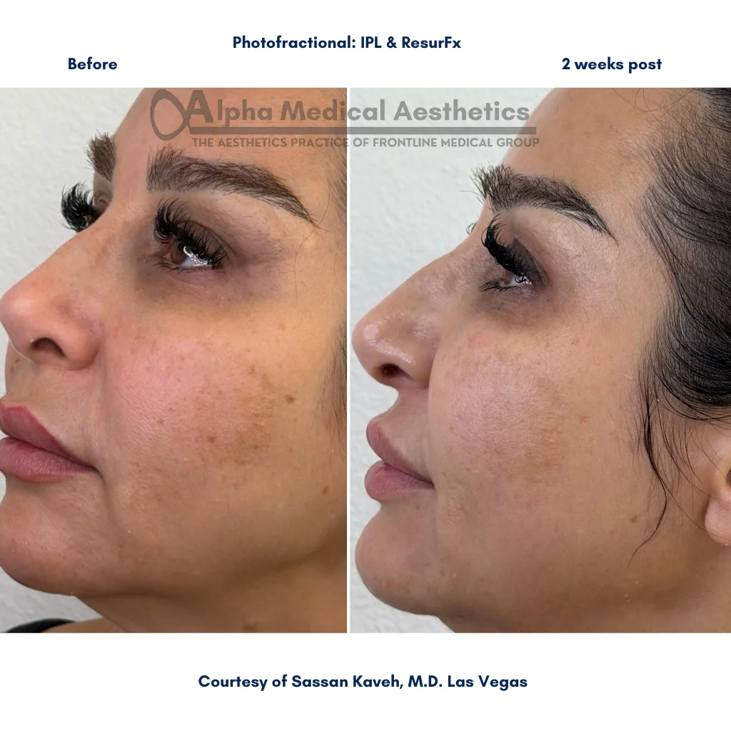Alpha_Medical_Aesthetics_Lumenis_Stellar_M22_IPL_ResurFX_Photofractional_Pigmentation_Removal_By_Dr._Sassan_Kaveh_Las_Vegas