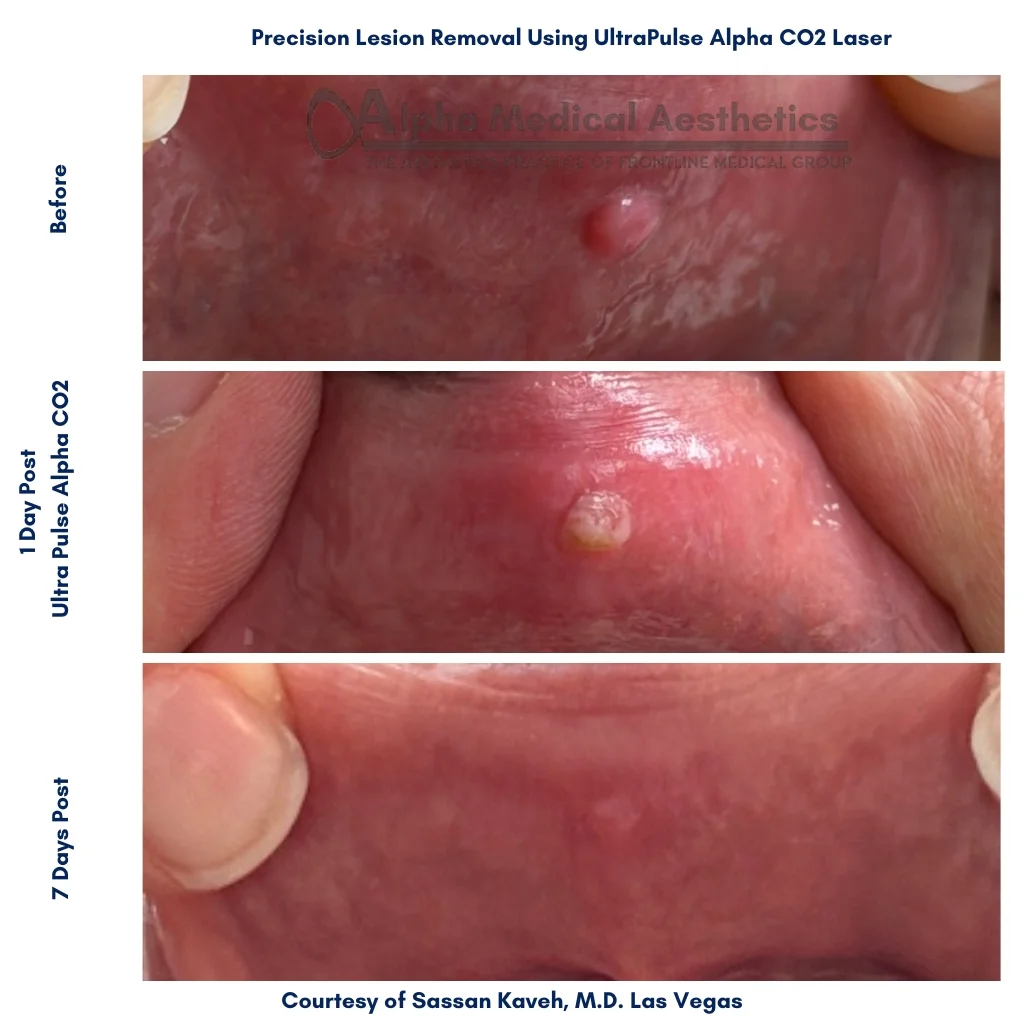 Alpha Medical Aesthetics Lumenis UltraPulse Alpha CO2 Laser Precision Lesion Removal By Dr. Sassan Kaveh Summerlin Las Vegas Alpha_Medical_Aesthetics_Lumenis_UltraPulse_Alpha_CO2_Laser_Precision_Lesion_Removal_By_Dr._Sassan_Kaveh_Summerlin_Las_Vegas
