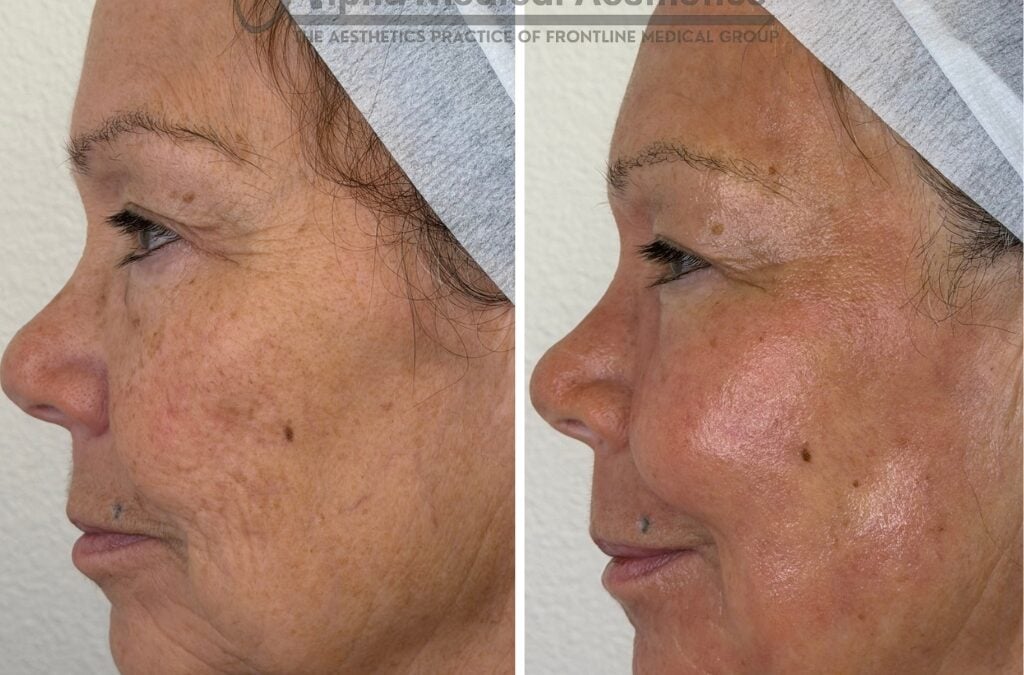 Why We Don’t Do Botox at Alpha Medical Aesthetics: A Physician’s Case for Collagen Over Neuromodulators
