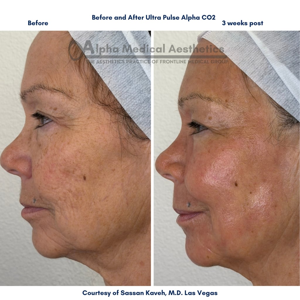 Alpha_Medical_Aesthetics_Lumenis_UltraPulse_Alpha_CO2_Laser_Treatment_Wrinkle_Removal_Dr._Sassan_Kaveh_Las_Vegas