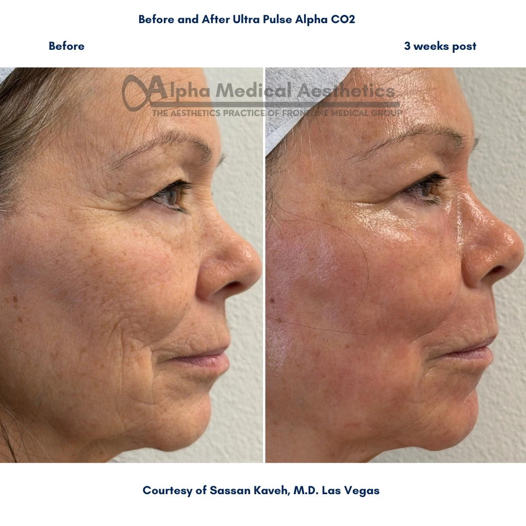 Alpha Medical Aesthetics Offers Lumenis UltraPulse Alpha CO2 Laser Treatment for Wrinkles Removal By Dr. Sassan Kaveh in Spring Valley Las Vegas Alpha_Medical_Aesthetics_Lumenis_UltraPulse_Alpha_CO2_Laser_Treatment_Wrinkles_Removal_By_Dr._Sassan_Kaveh_Spring_Valley_Las_Vegas