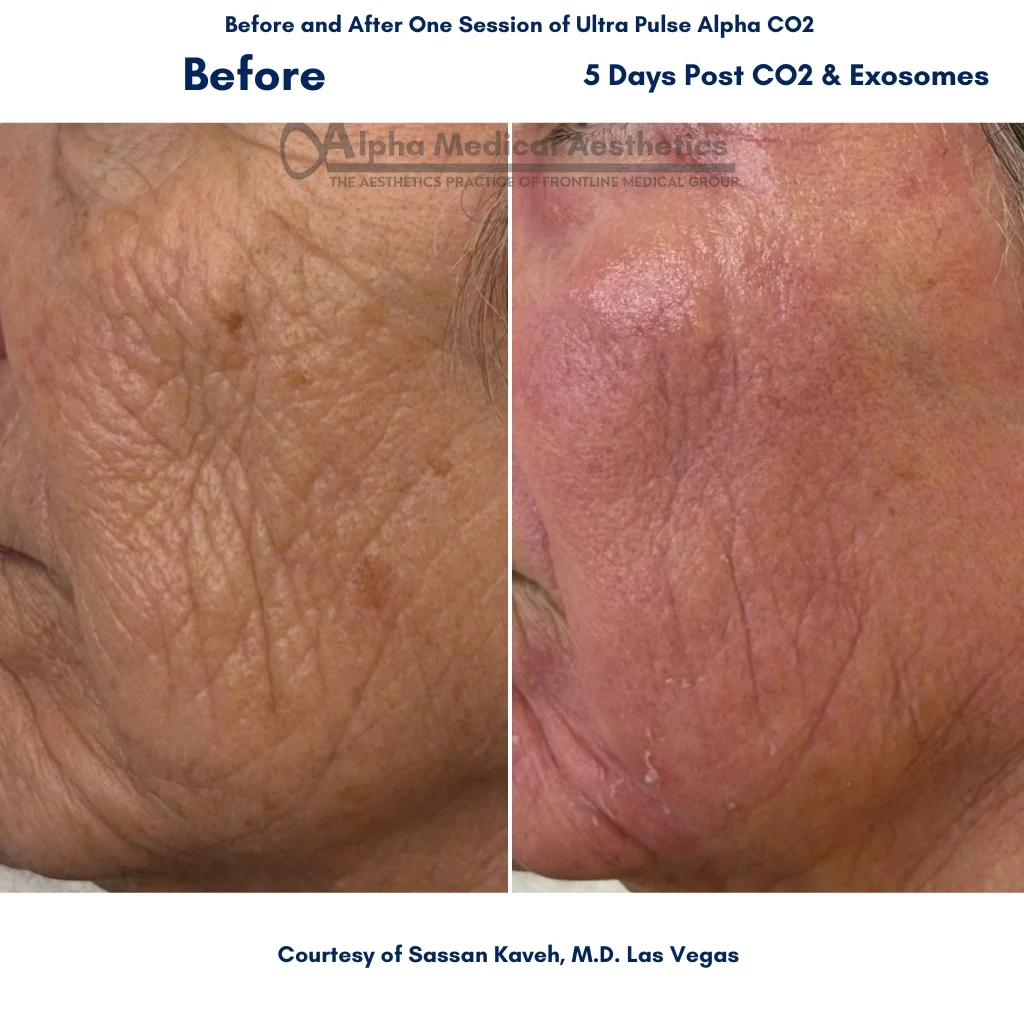 Alpha_Medical_Aesthetics_Lumenis_UltraPulse_Alpha_CO2_Laser_With_Exosomes_Sun_Damage_Treatment_By_Dr._Sassan_Kaveh_Spring_Valley_Las_Vegas