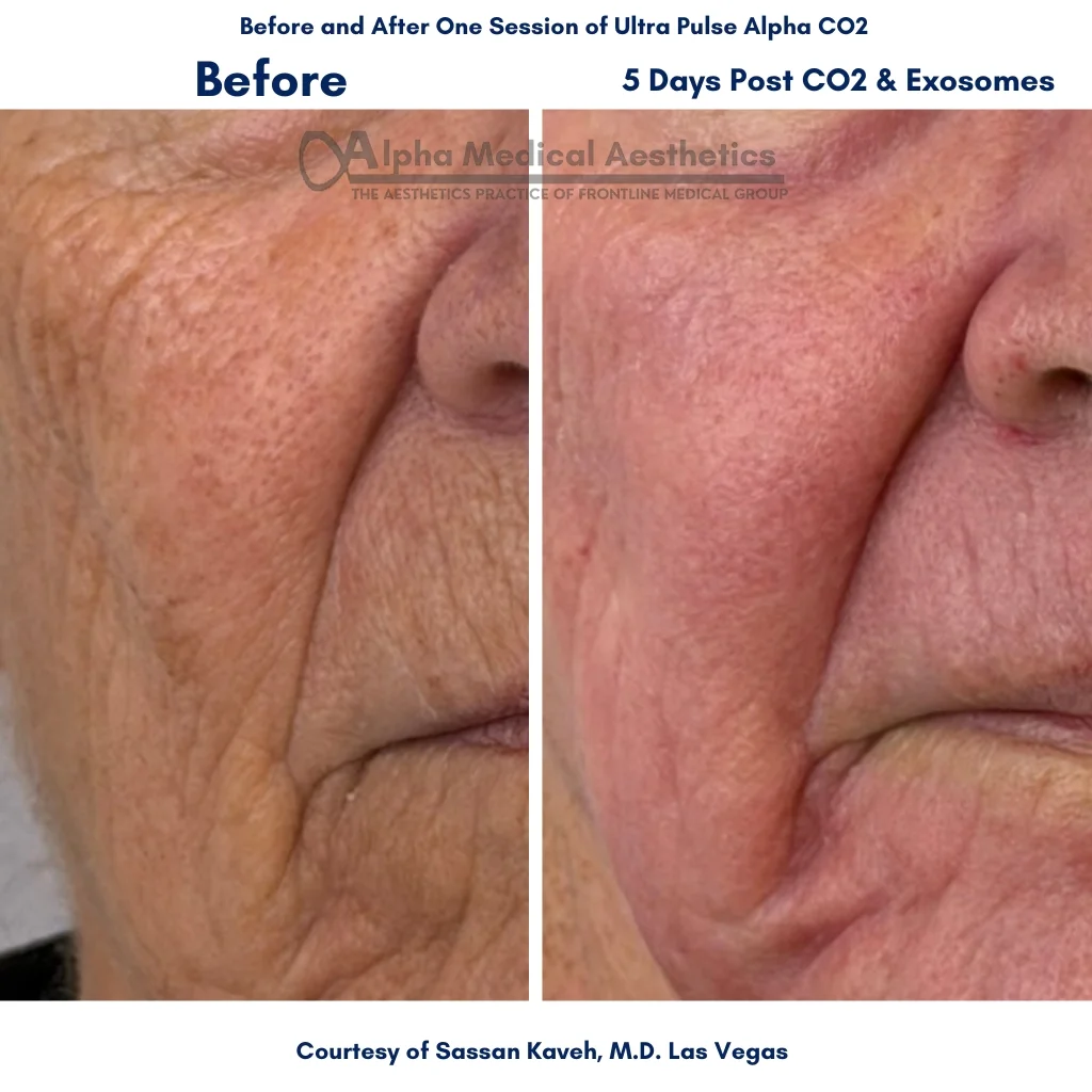 Alpha_Medical_Aesthetics_Lumenis_UltraPulse_Alpha_CO2_Laser_With_Exosomes_Wrinkle_Smoothing_By_Dr._Sassan_Kaveh_Peccole_Ranch_Las_Vegas