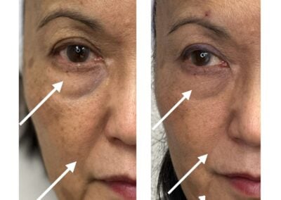 Alpha Medical Aesthetics Lumenis triLift By Dr Sassan Kaveh Las Vegas