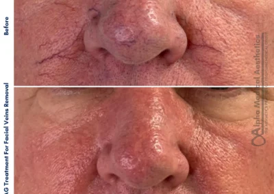 Alpha Medical Aesthetics Nd Yag Facial Vein Removal Facial Treatment By Dr. Sassan Kaveh Canyon Gate Las Vegas 310