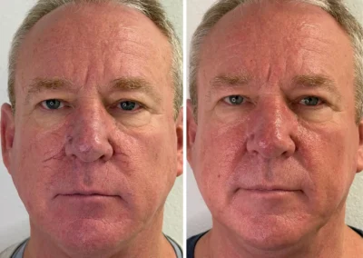 Alpha Medical Aesthetics Nd Yag Facial Vein Removal Facial Treatment By Dr. Sassan Kaveh Desert Shores Las Vegas 303