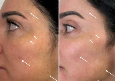 Alpha Medical Aesthetics Photofractional IPL and ResurFX Facial Treatment By Dr. Sassan Kaveh Henderson Las Vegas 048