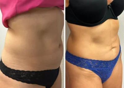 Alpha Medical Aesthetics RF TriPollar Skin Tightening Facial Treatment By Dr. Sassan Kaveh Canyon Gate Las Vegas 313