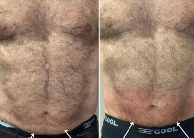 Alpha Medical Aesthetics RF TriPollar Skin Tightening Facial Treatment By Dr. Sassan Kaveh Desert Shores Las Vegas 145