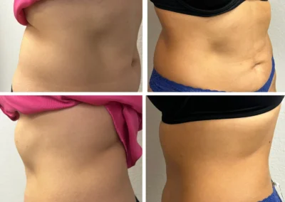 Alpha Medical Aesthetics RF TriPollar Skin Tightening Facial Treatment By Dr. Sassan Kaveh Downtown Las Vegas 312