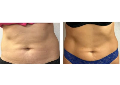 Alpha Medical Aesthetics RF TriPollar Skin Tightening Facial Treatment By Dr. Sassan Kaveh Peccole Ranch Las Vegas 311